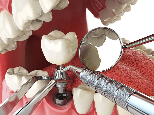 Best Emergency Dental Care for Broken or Chipped Teeth in South Coatesville, PA